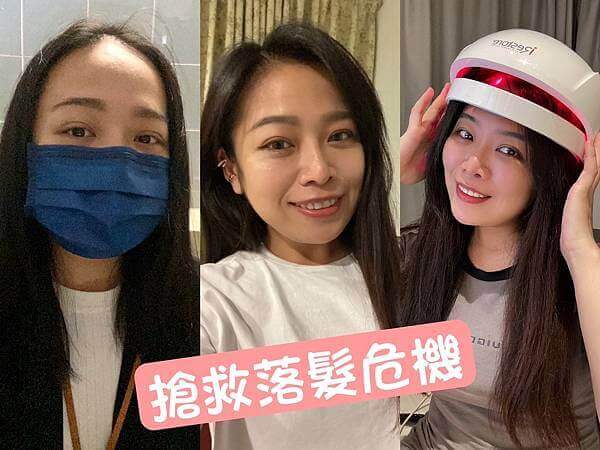 【使用見證文章】iRESTORE雷射生髮帽半年心得全紀錄,自信回來了!