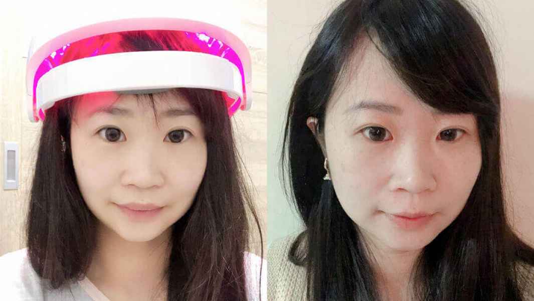 【使用見證文章】拒絕持續掉髮…iRESTORE雷射生髮帽幫我找回自信! 產後使用半年體驗成果公開